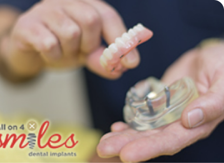 Dental Implants