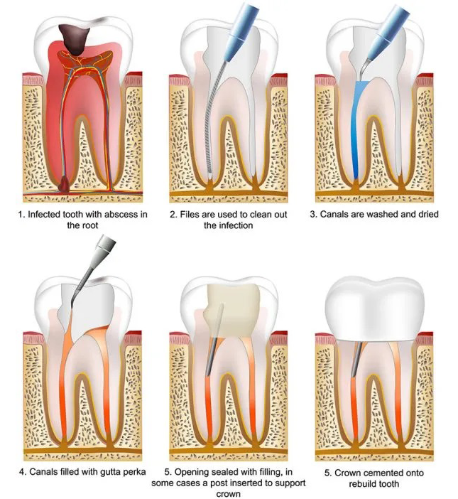 Root canal treatment