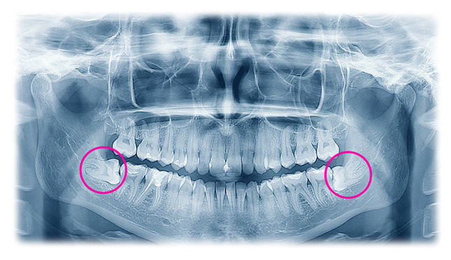 Wisdom teeth removal